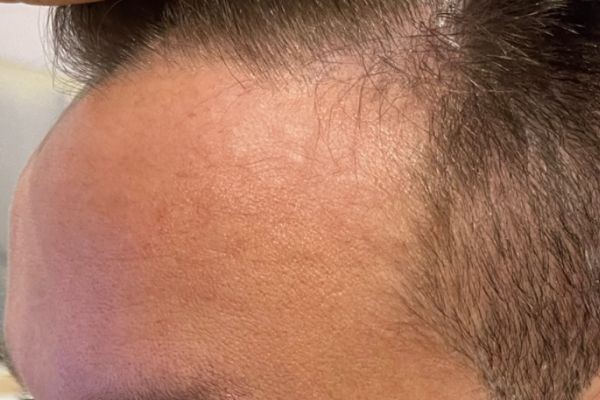 homem-calvo-04-antes