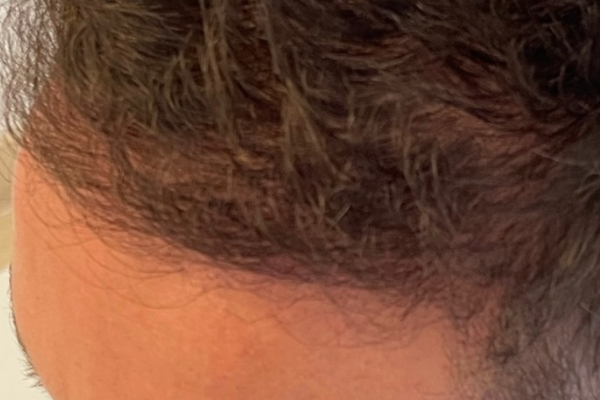 homem-calvo-04-depois